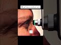 شاهد طريقة قياس ضغط العين