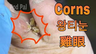 Corns between toes, 발가락 사이에 꼭꼭 숨어있는 왕티눈, 腳趾縫雞眼