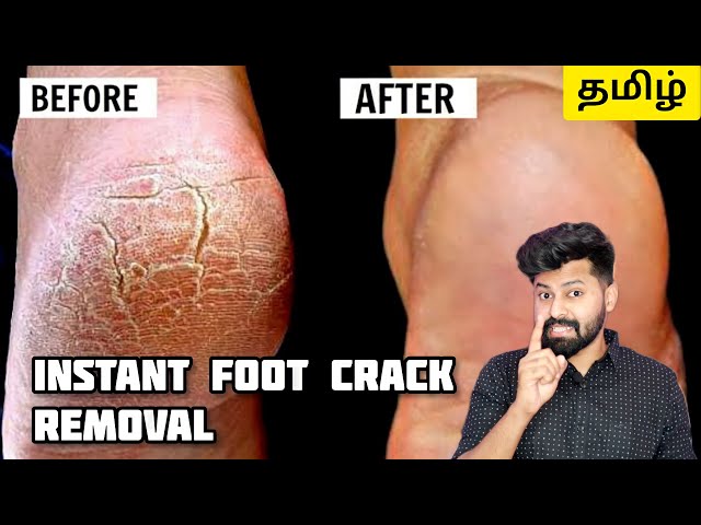 Instantly Remove Foot Cracks | Tamil | English Subtitles | Shadhik Azeez -  YouTube