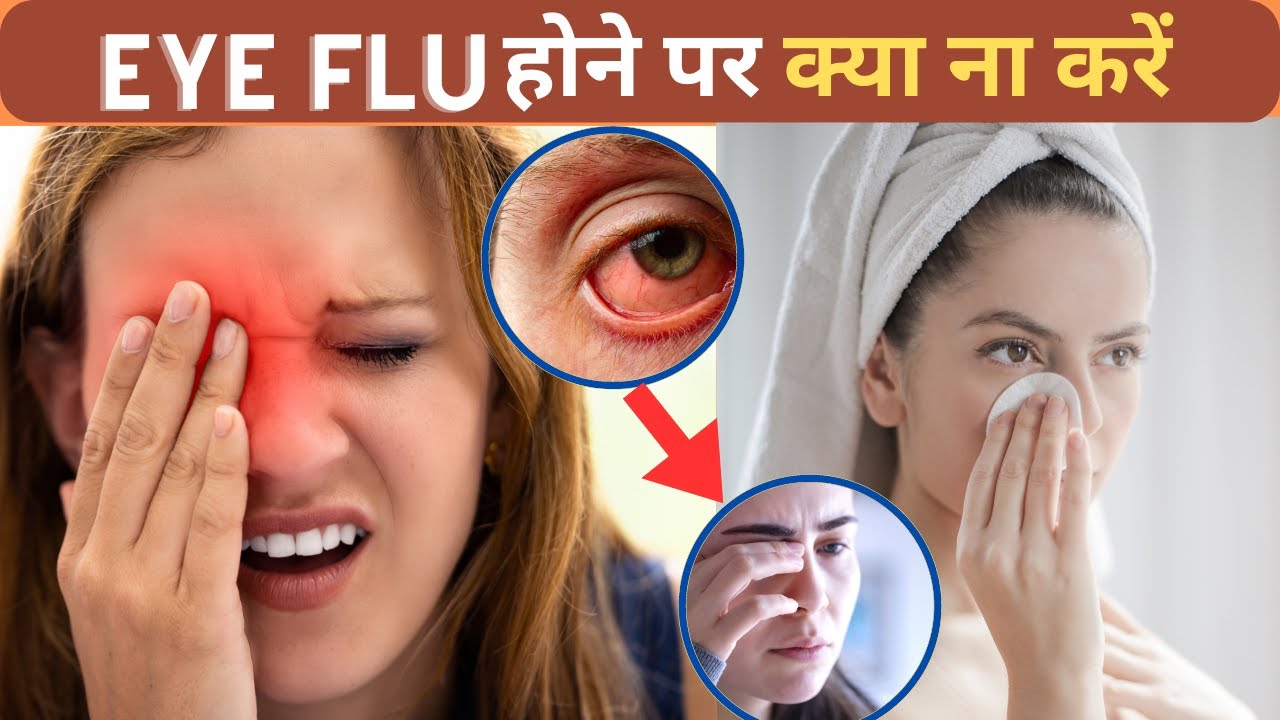 Eye Flu Hone Par Kya Kare Kya Na Kare आई फ्लू होने पर क्या ना करें