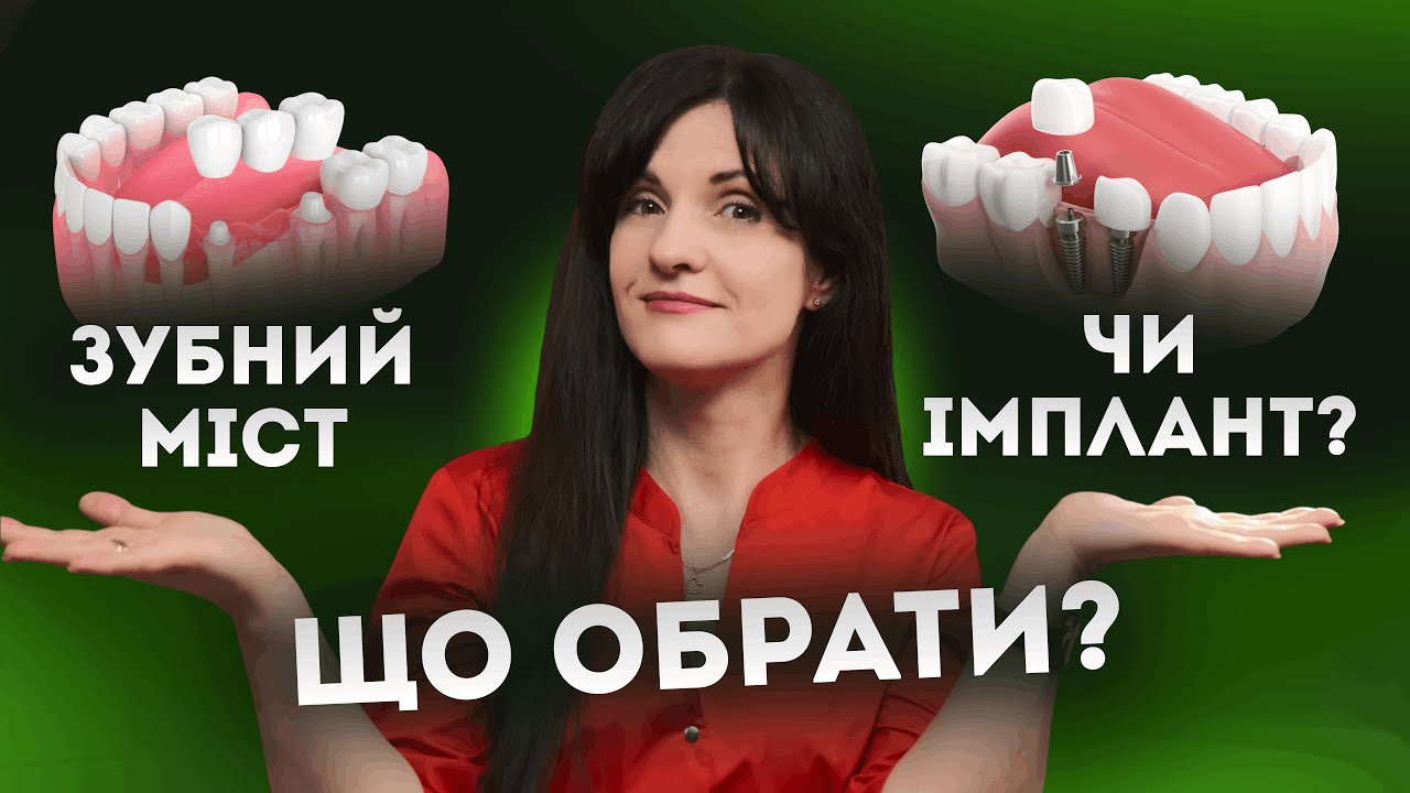 Зубний МІСТ чи ІМПЛАНТИ? Що краще?!