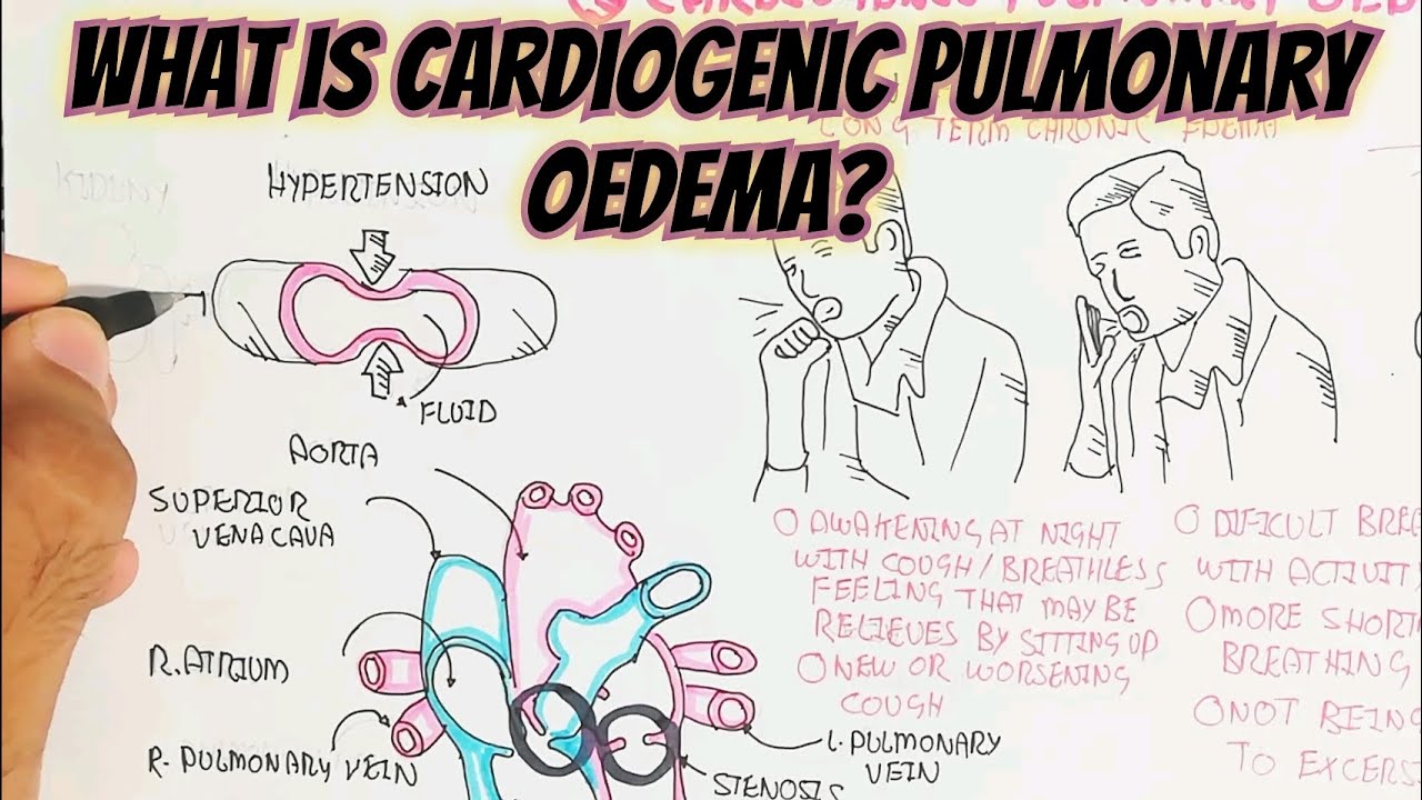 What Is Cardiogenic Pulmonary Oedema umerfarooqbiology7083 YouTube What Is Cardiogenic Pulmonary Oedema umerfarooqbiology7083 YouTube