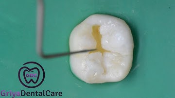 Composite Class 1 Incremental Layering...