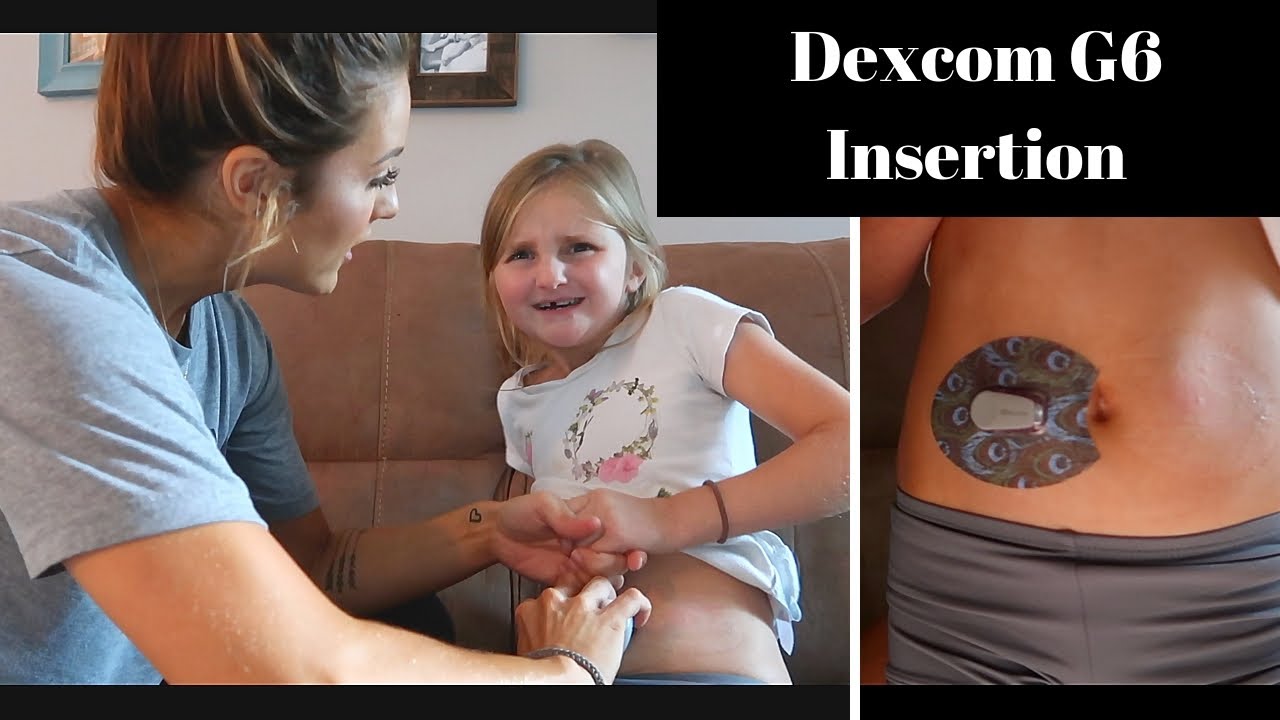 Dexcom G6 — Auto Insertion Video 