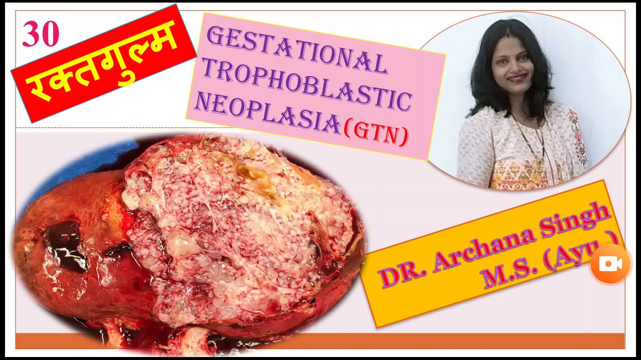 30. रक्त गुल्म -Gestational Trophoblastic Neoplasia (GTN)