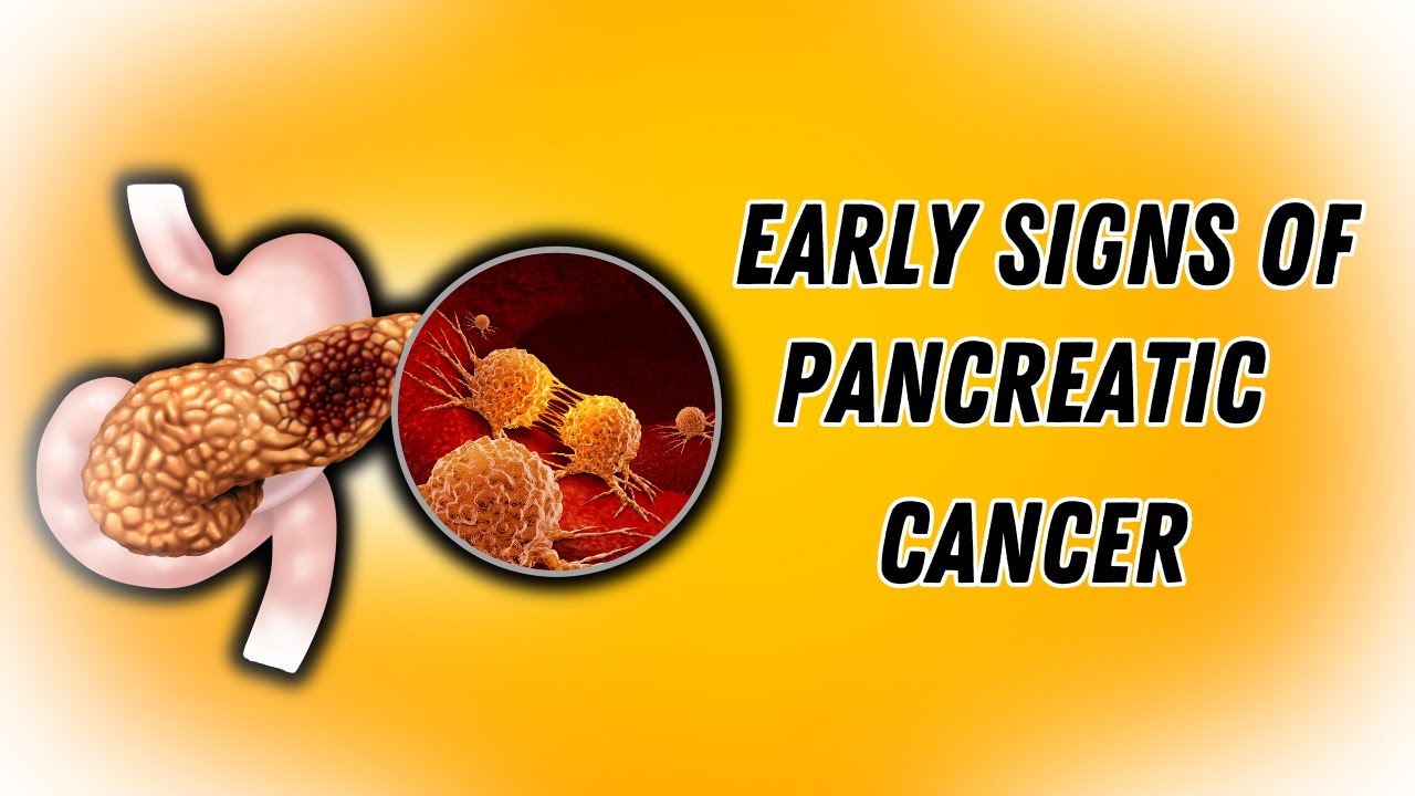 Pancreatic Cancer Early Signs You Must Have to Know About / Pancreatic ...