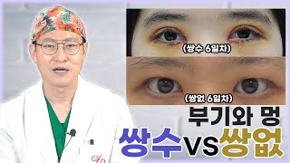 쌍수 후에 생기는 부기와 멍! 과연 쌍없수술을 해도 생길까요? | 라리성형외과