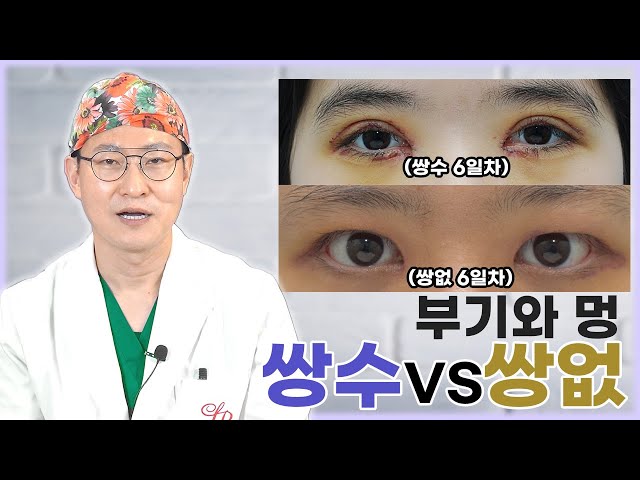 쌍수 후에 생기는 부기와 멍! 과연 쌍없수술을 해도 생길까요? | 라리성형외과