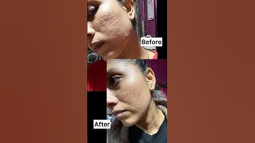 My At Home DermaRoller Results / Microneedling Treatment #shorts #ashortaday #acnescars
