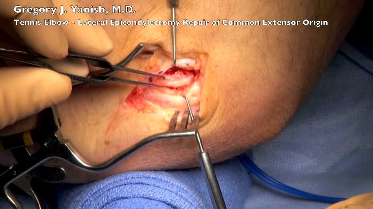 Tennis Elbow Lateral Epicondylectomy And Repair Common Extensor