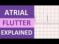 Atrial Flutter Quiz