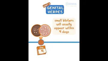 Genital Herpes Pt 2 