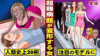 【実話】超難病・顔面が変形する女…人類史上２０例。世界が注目するモデルに。