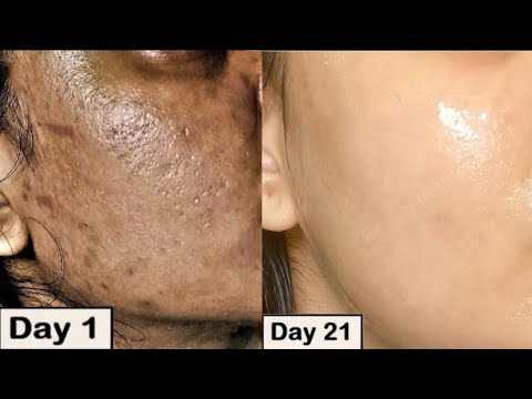 Damaged Skin Repair - DIY Damaged Skin Treatment At Home - YouTube