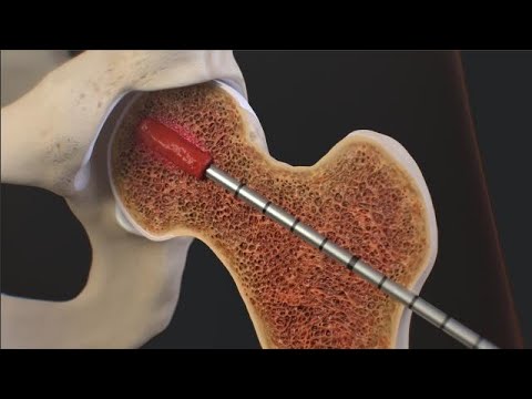 IntraOsseous BioPlasty® (IOBP)