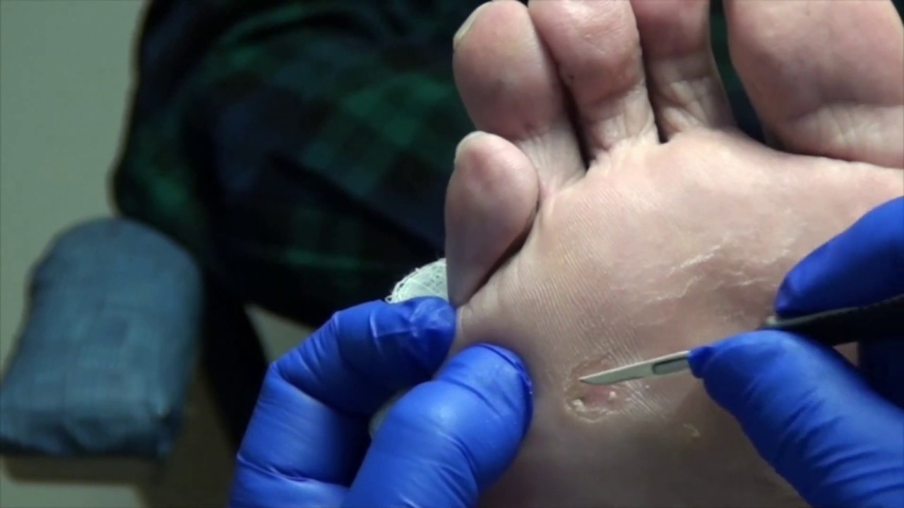Trimming a Callus - Set to Music Trimming a Callus - Set to Music