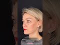 Расширенная нижняя блефаропластика с перемещением грыж в носослезные борозды