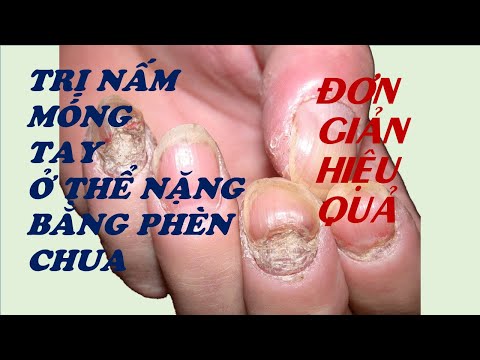 Công Thức Thu Gọn Của Phèn Chua - TRỊ NẤM MÓNG TAY Ở THỂ NẶNG BẮNG PHÈN CHUA, PHƯƠNG PHÁP ĐƠN GIẢN, HIỆU QUẢ, KHÔNG TỐN KÉM.