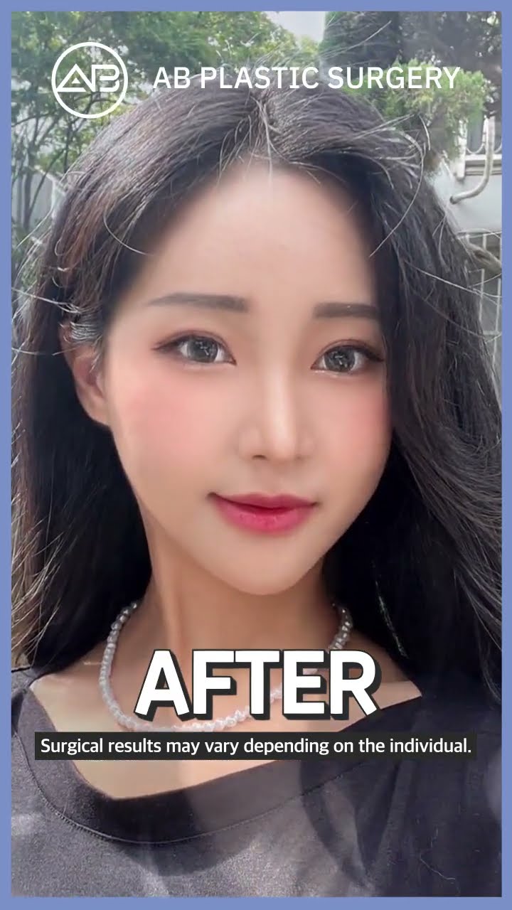 [Plastic Surgery in Korea] I got prettier with 3 type facial contouring #shorts