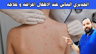 اعراض الجدري المائي عند الاطفال و طرق الوقايه و العلاج