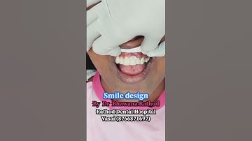 “From Ordinary to Perfect Smile –Veneers Magic😍”#smiledesign#magic#vasaidentist #transition#dentist