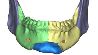 Face engineering - five piece mandible by Dr Paul Coceancig 1,321 views 1 year ago 16 seconds