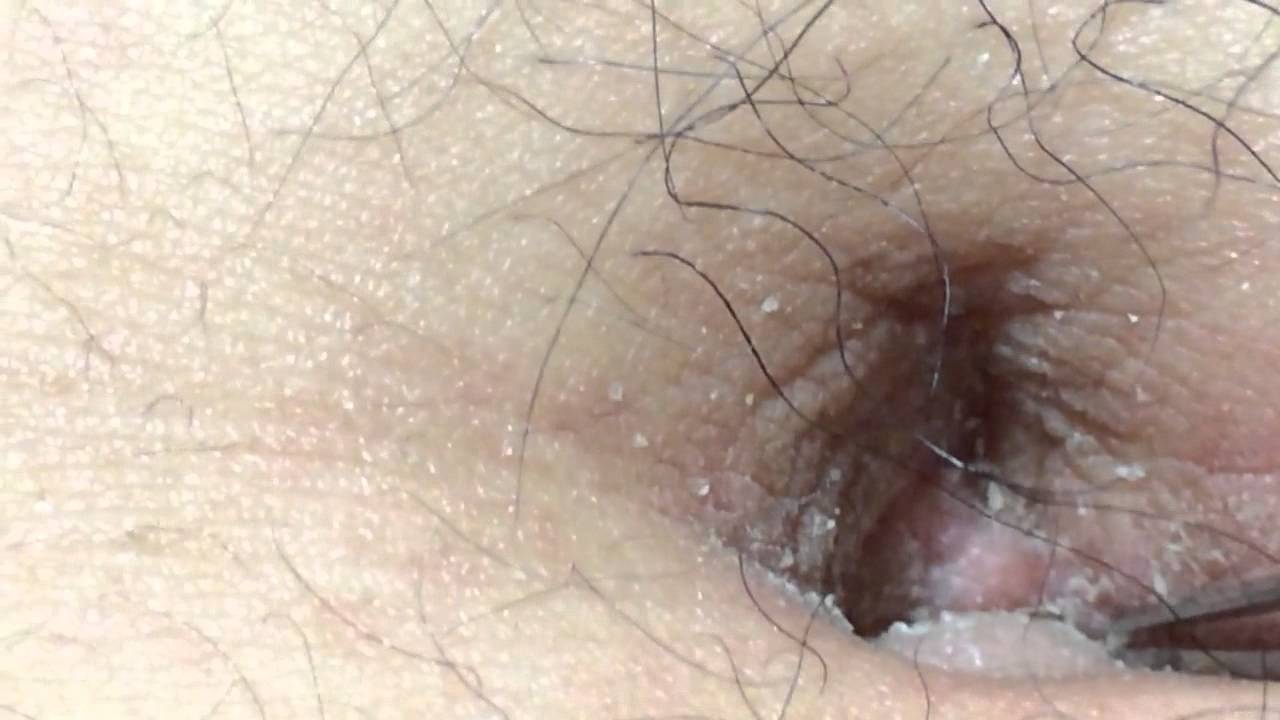 巨大なへそのゴマの除去２ Take Navel Fluff Youtube
