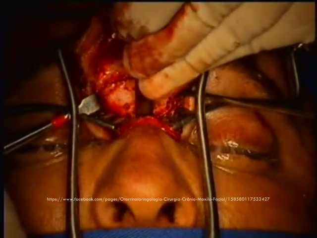 Ethmoidal Osteoma.wmv