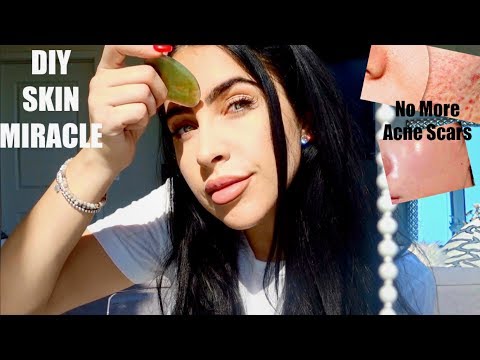 DIY ACNE SCAR REMOVER | How To Get Rid of Acne Scars Naturally + Fast (Easy At Home + Clears Skin!!)