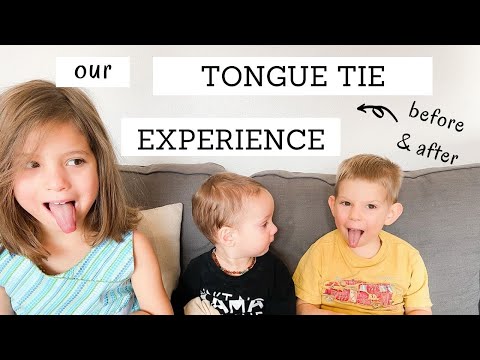 私たちの舌小帯短縮症|前後の舌小帯短縮症|マルハナバチ薬剤師