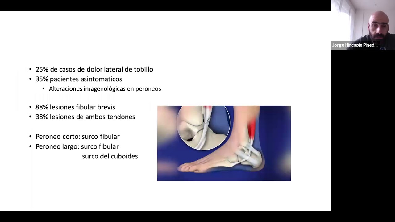 Patologia de peroneos - YouTube