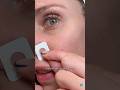 How An Esthetician Gets Rid Of A Pimple In 1 Day!! Zitsticka Killa Patch #zitsticka #acne #skincare
