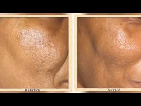 Dermalogics Before &amp; After - Acne Scars &amp; Medical Micro 