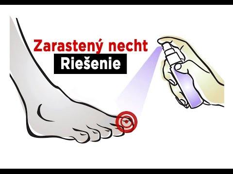 Video: Narastie plesňový necht na nohe?