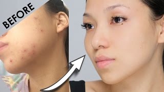 Remove Acne Marks | 3 Home Remedies (100% Works) With Results screenshot 3