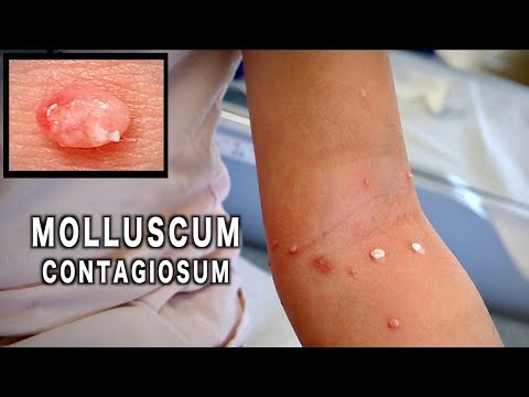 Video: Molluscum Contagiosum Hos Barn - Behandling, Borttagning