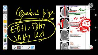 Topic Head injury 5 Cerebral hemorrhage EDH SDH SAH ICH