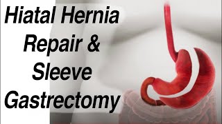 Hiatal Hernia Repair & Sleeve Gastrectomy Weight Loss Surgery Animation