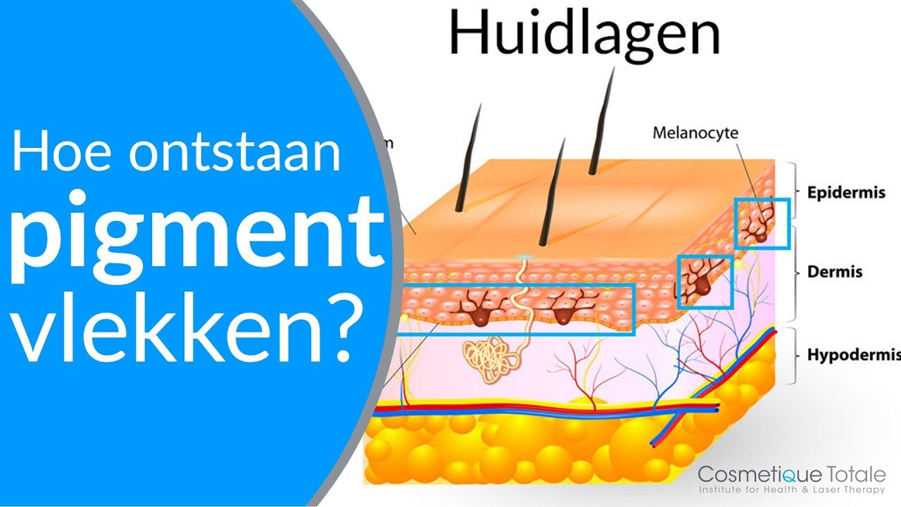 PIGMENTVLEKKEN - Hoe ontstaan pigmentvlekken - (Wat zijn pigmentvlekken