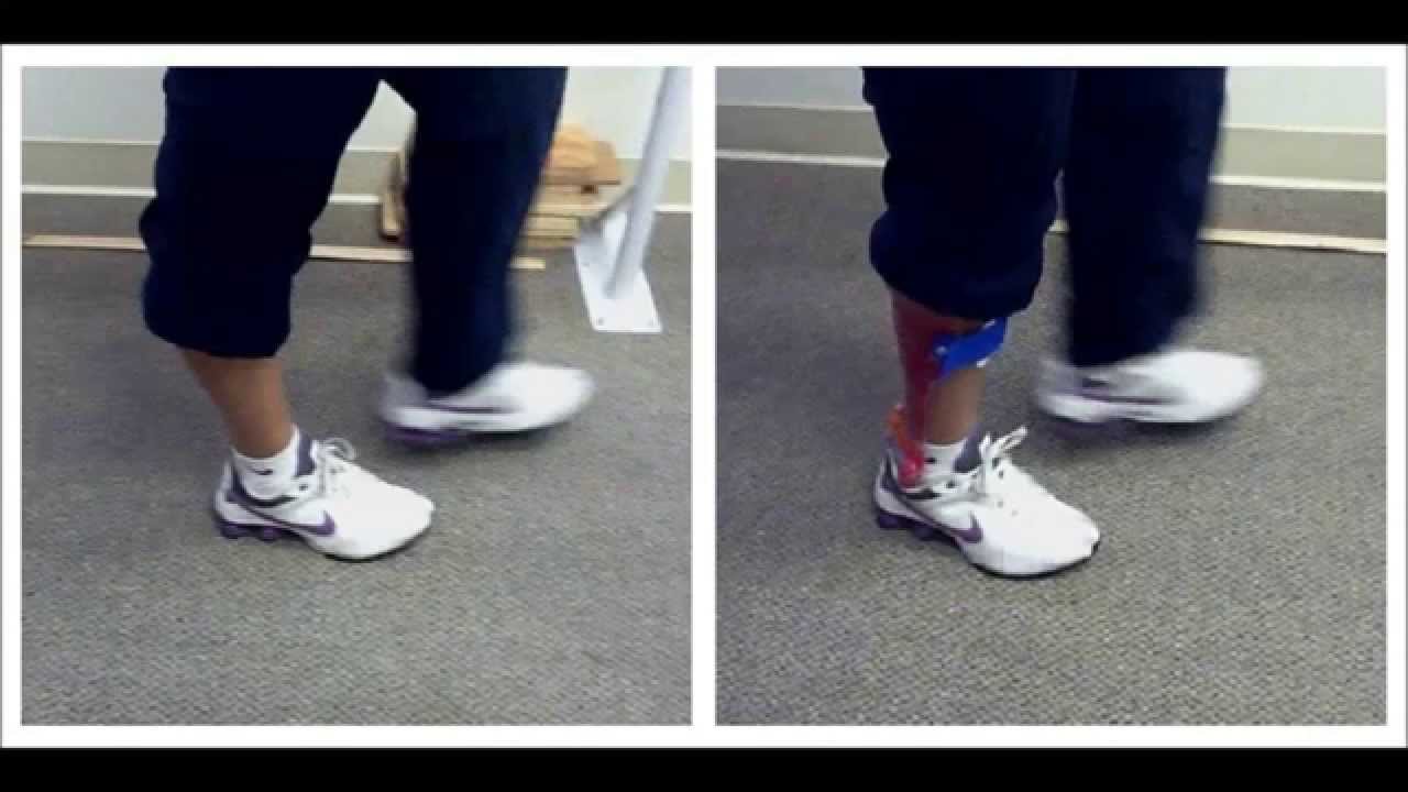 Afo For Knee Hyperextension Youtube