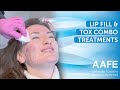 Lip fill  tox combo treatments