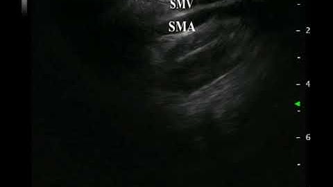 Video 8 Scanning Pancreatic Uncinate Process from the Stomach and Duodenum