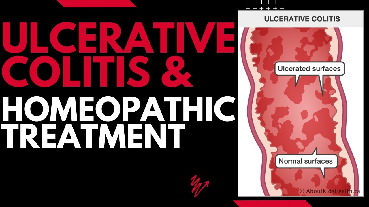 ulcerative colitis ||  ulcerative colitis homeopathic medicine !