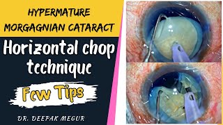 Tips For Safe Horizontal Chopping In Morgagnian Cataract- Free Floating Nucleus - Dr Deepak Megur
