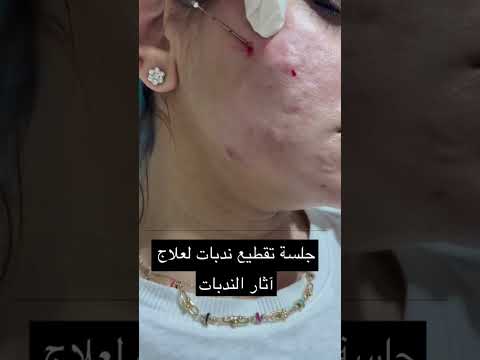 جلسة تقطيع الندبات وحقن بلازما