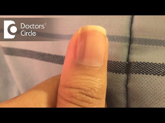 What does a brown straight line in the middle of the fingernail mean? -  Quora