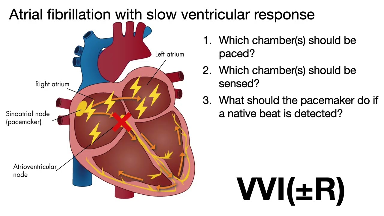 Spikes and Strikes: Mastering the Essentials of Cardiac Devices