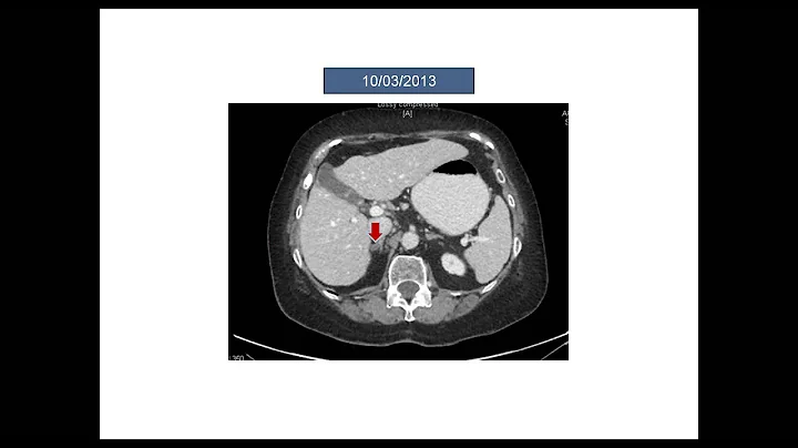 The Role of Immunotherapy in Non Small Cell Lung Cancer NSCLC