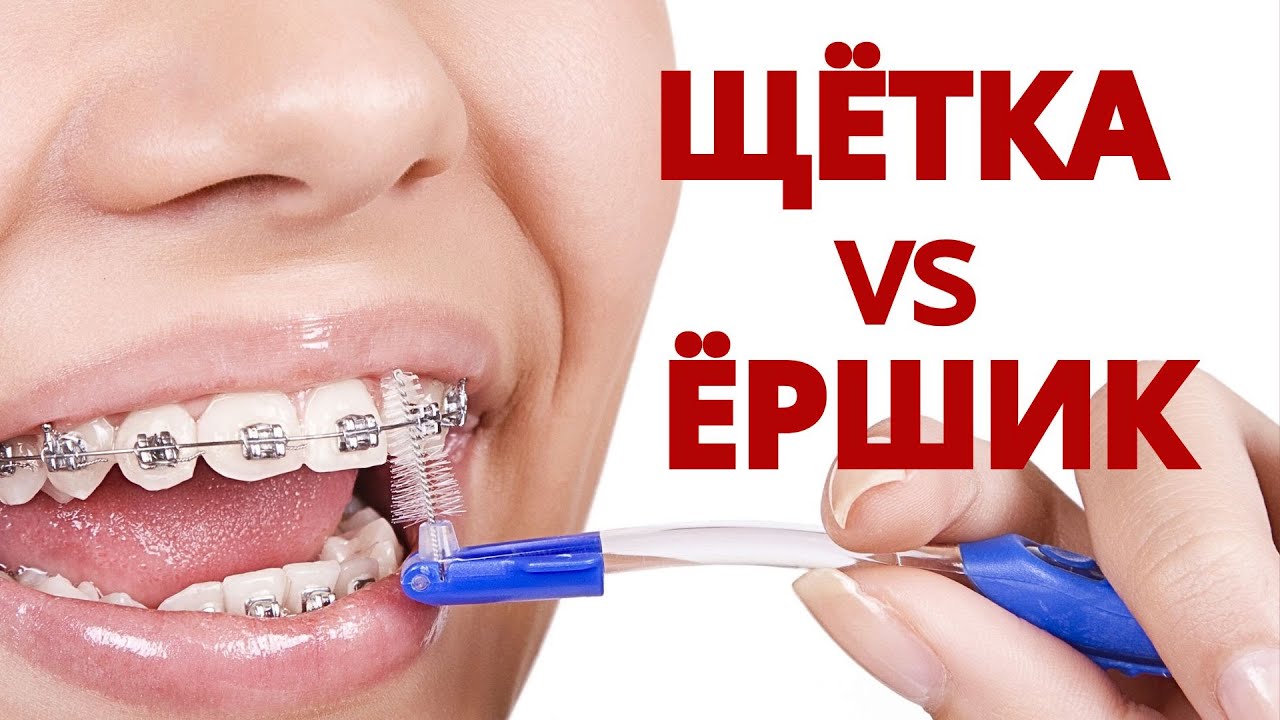 ЧЕМ ЧИСТИТЬ ЗУБЫ С БРЕКЕТАМИ | Где купить? Что выбрать?