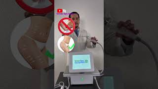 Como reafirmar el abdomen con Radiofrecuencia Fraccionada. #shorts #radiofrecuenciafraccionada